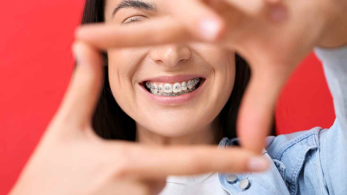 A Woman Smiling with her buck teeth after getting treated by braces an example of buck teeth treatment options.