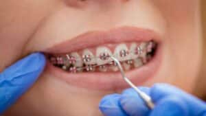 A Woman with Braces for Buck Teeth Treatment