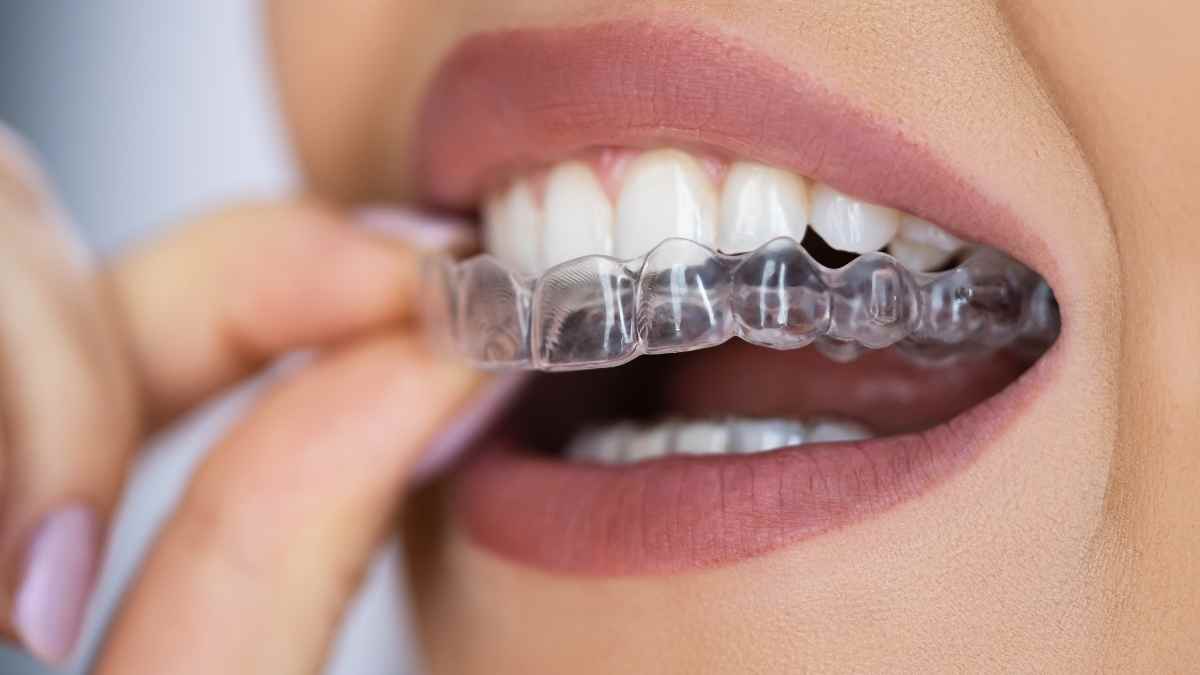 Invisalign for teeth