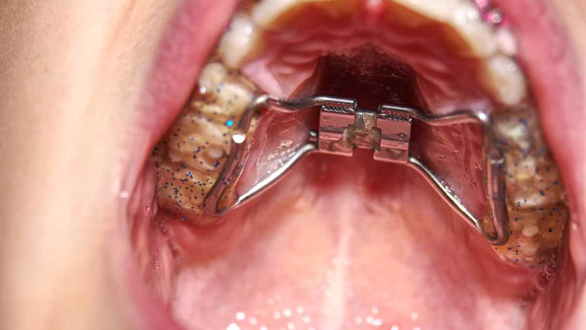 Palatal Expanders for Buck teeth